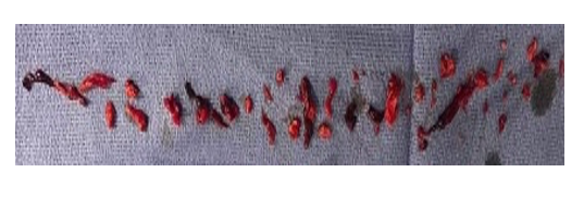 VentiV Clot Figure 1