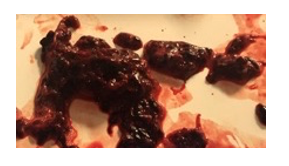 VentiV Clot Figure 2