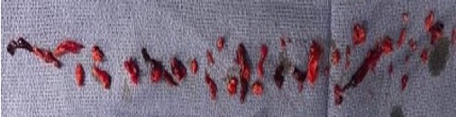 VentiV Mechanical Thrombectomy system clot removal 1