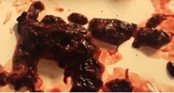 VentiV Mechanical Thrombectomy system clot removal 2