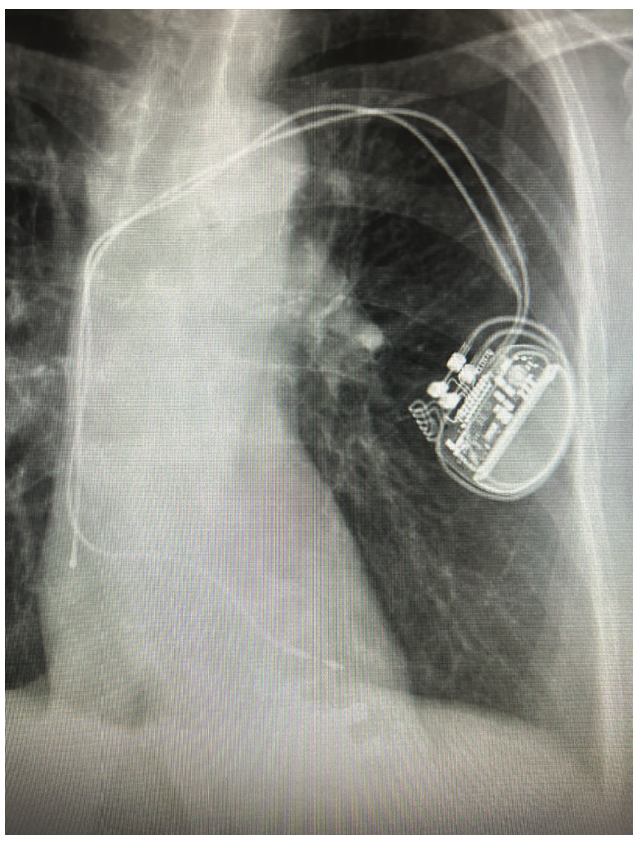 Verma Lead Extraction Figure 1