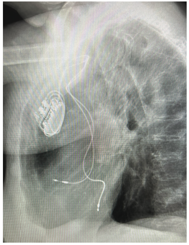 Verma Lead Extraction Figure 2