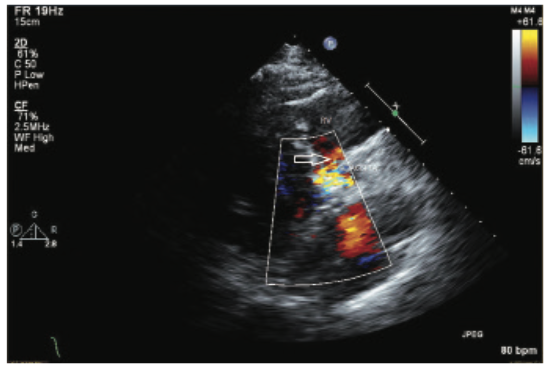 Verma TAVR Figure 1