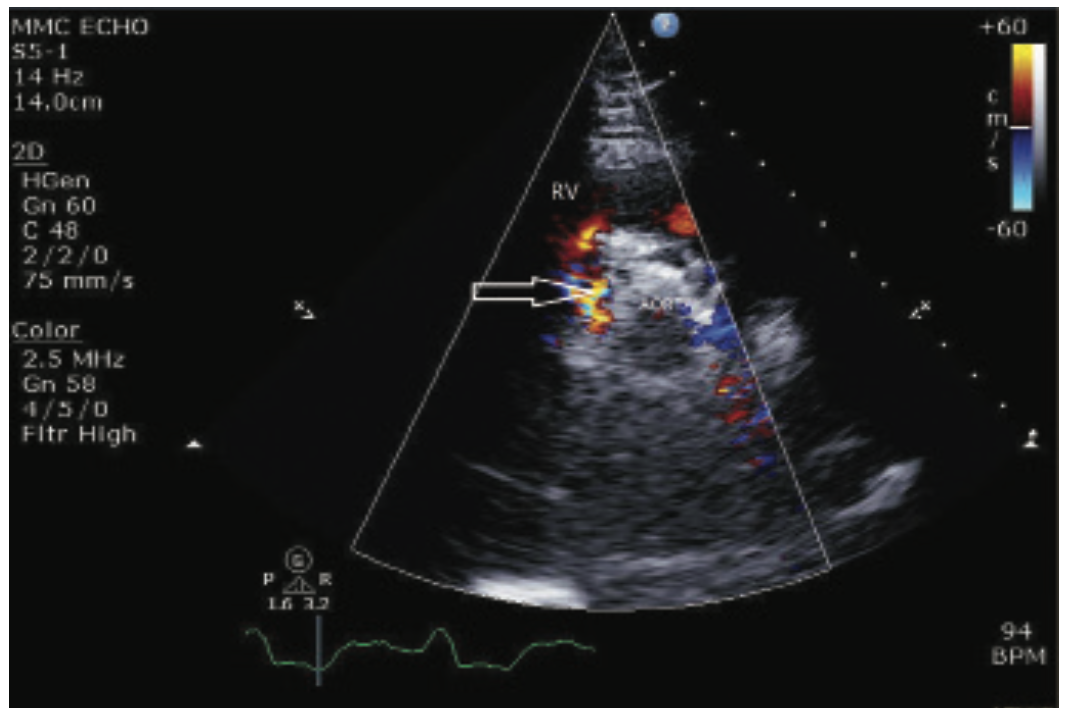Verma TAVR Figure 2