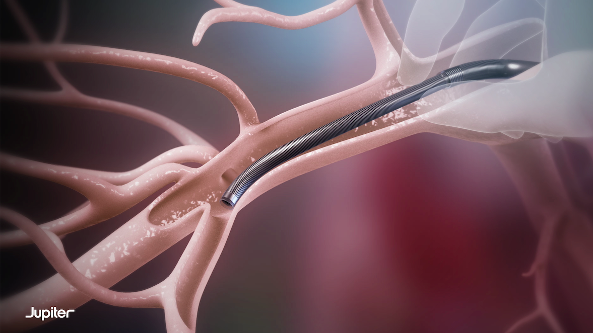 Vertex Pulmonary Embolectomy System (Jupiter Endovascular)