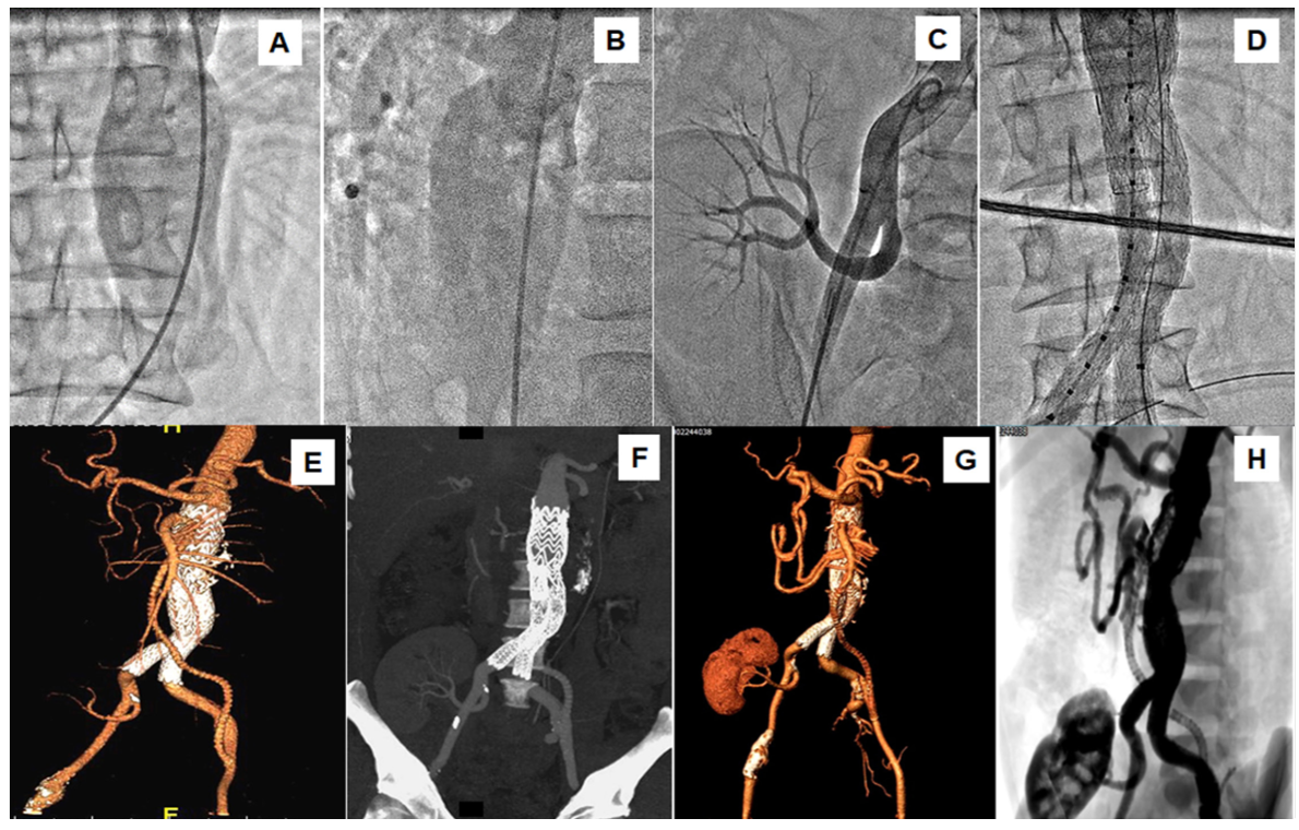 Vijayvergiya Aneurysm Figure 1
