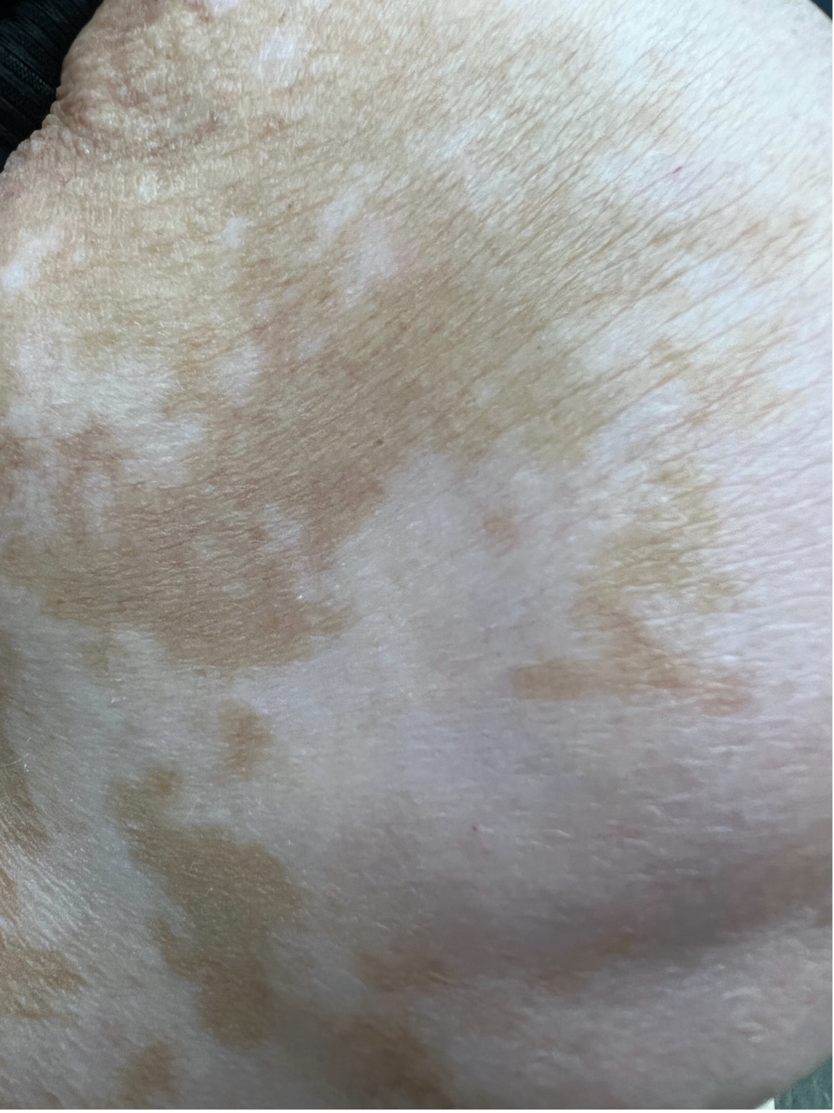 What are these white macules? 