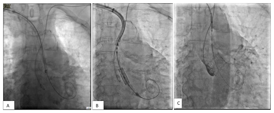 Waleed Figure 2. A 14-Fr Edwards eSheath is inserted via the right axillary artery and placed just above the aortic annular level.