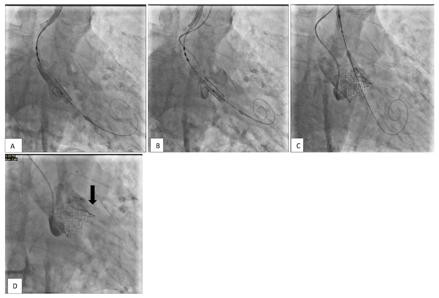 Waleed Figure 3. Using the Edwards Commander system, clockwise articulation of the pusher catheter helped achieve very good angulation.