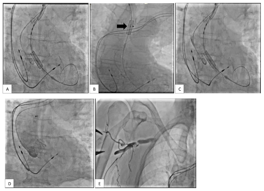 Waleed Figure 4. Using the retroflex, the S3 valve was in position to allow co-axial alignment.