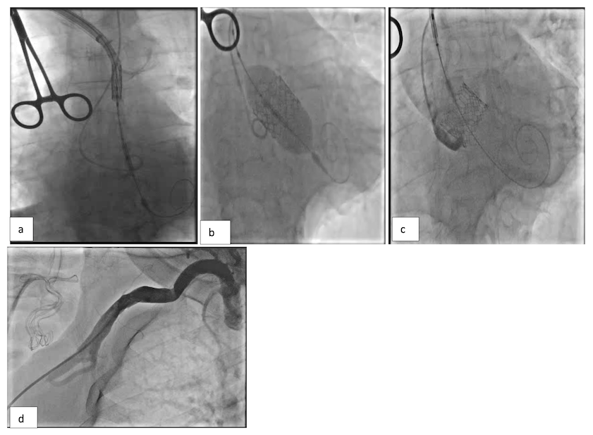 Waleed Figure 5. eSheath partially withdrawn back creating space to allow for valve loading on the balloon. 