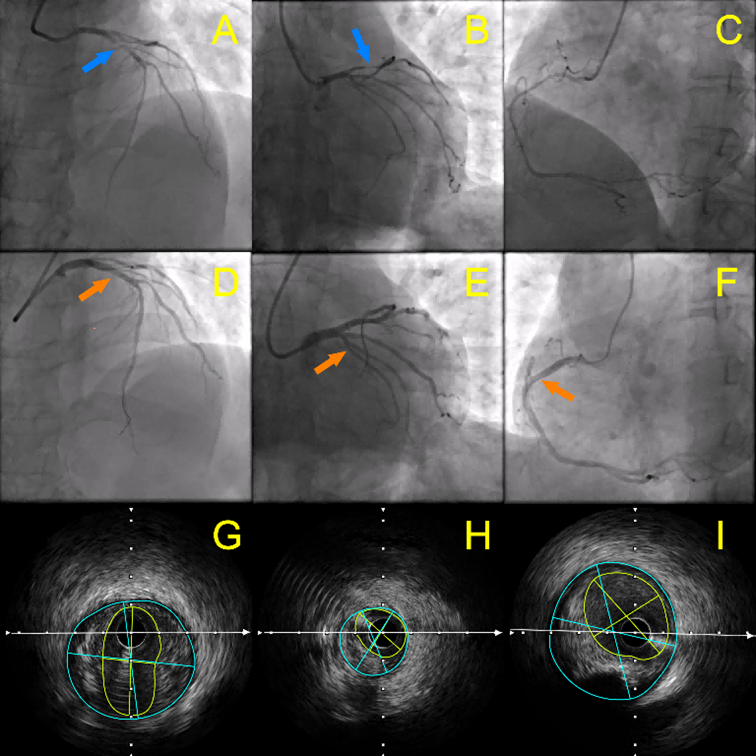  Figure. (A-C) Spastic coronary arteries