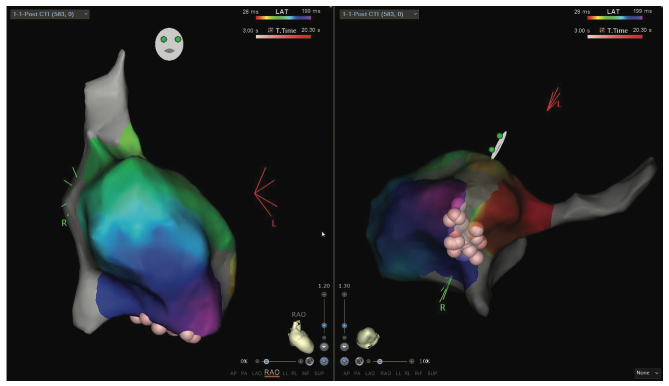 Whiteway Fluoroless Journey Figure 3