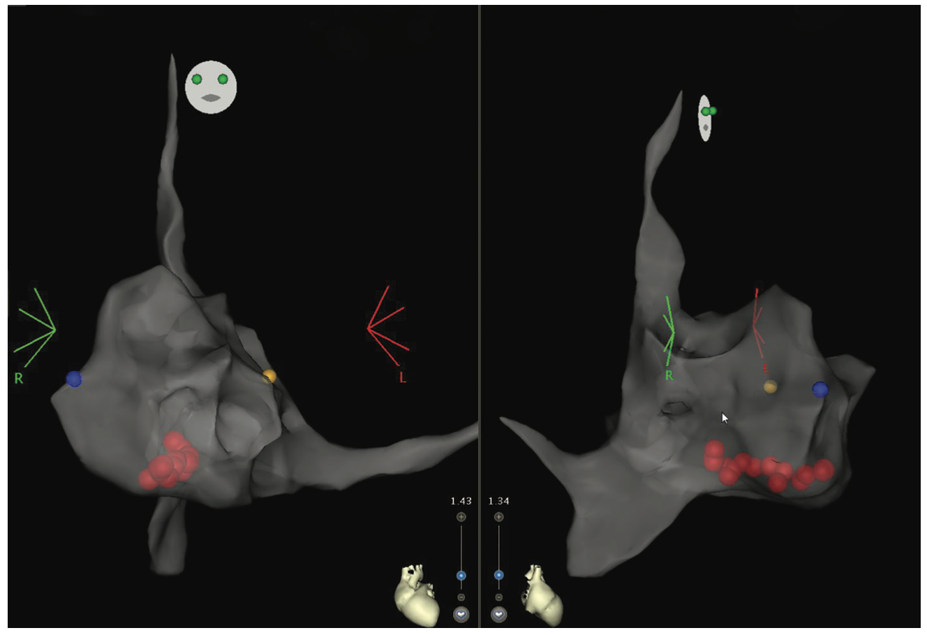 Whiteway Fluoroless Journey Figure 5