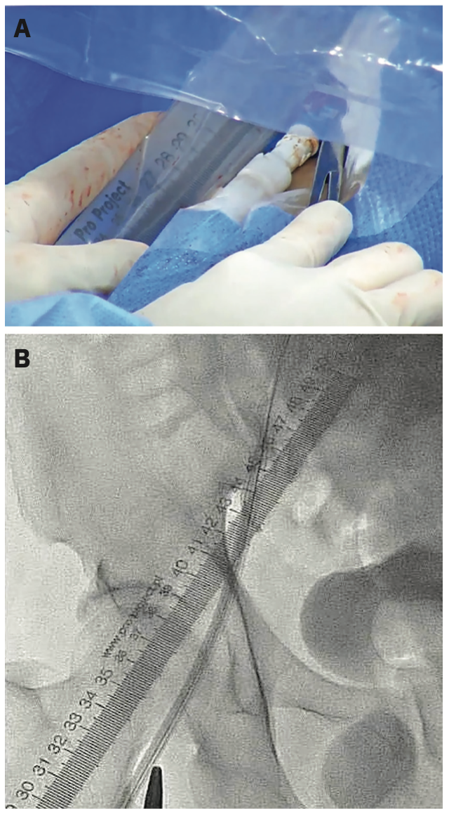 Wong Arteriotomy Figure 1