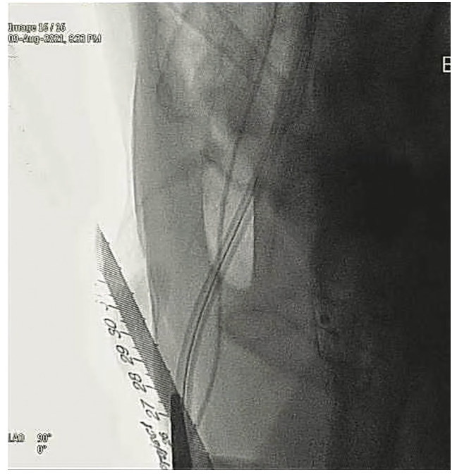 Wong Arteriotomy Figure 2