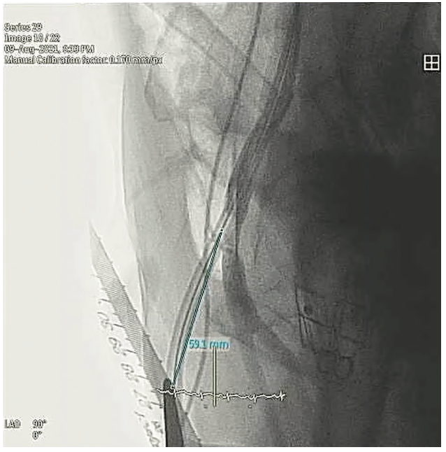 Wong Arteriotomy Figure 3