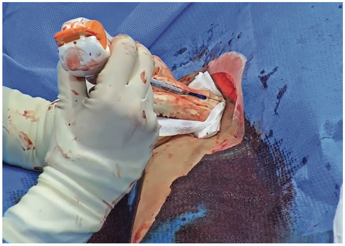 Wong Arteriotomy Figure 4