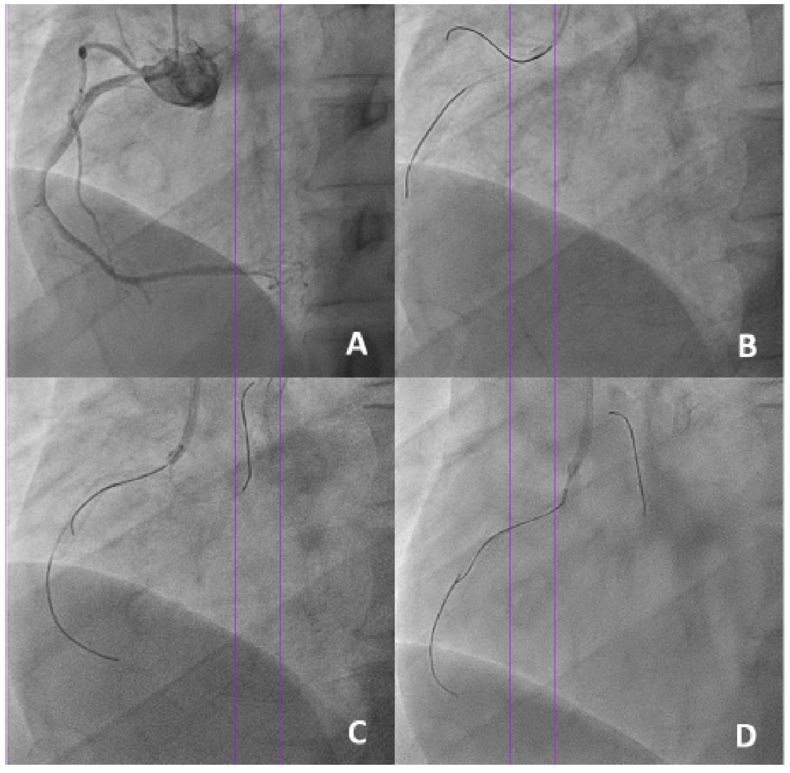 Wong Floating-Wire Technique Figure 1