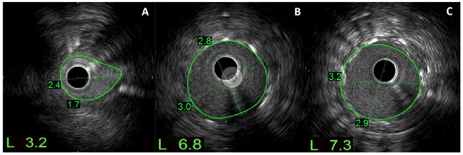 Wong Floating-Wire Technique Figure 2