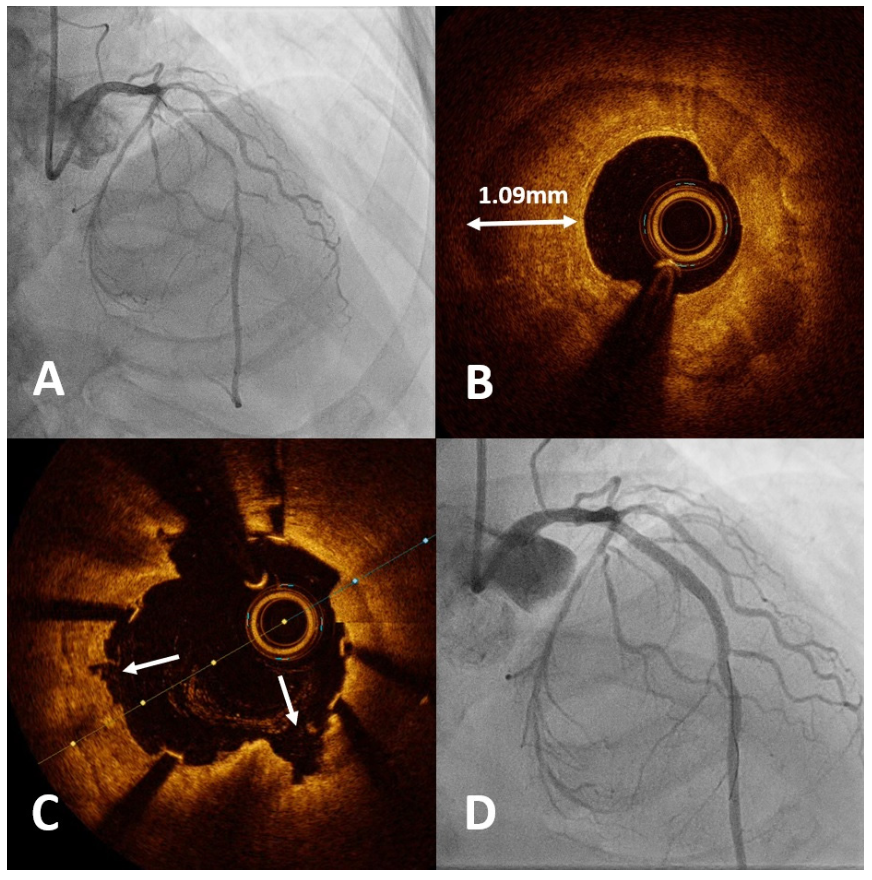Wong Intravascular Lithotripsy Figure 1