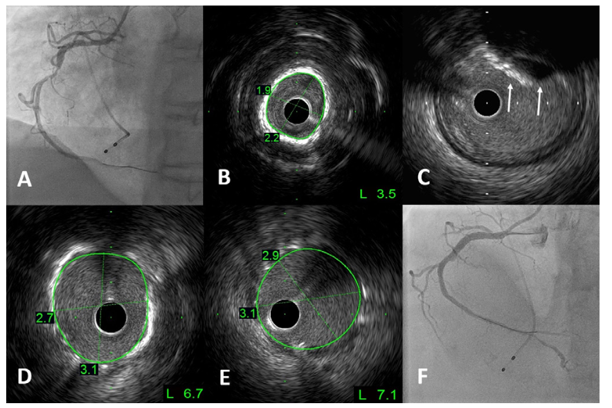 Wong Intravascular Lithotripsy Figure 2
