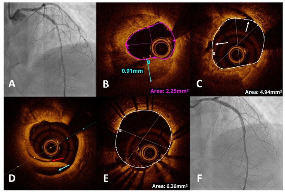 Wong Intravascular Lithotripsy Figure 3