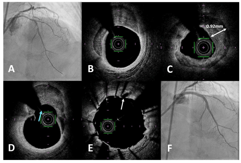 Wong Intravascular Lithotripsy Figure 4