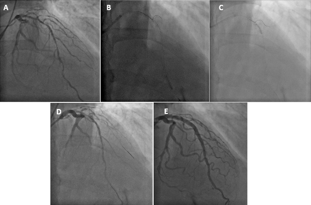 Figure 1. Wiring of angulated and diseased diagonal branch 