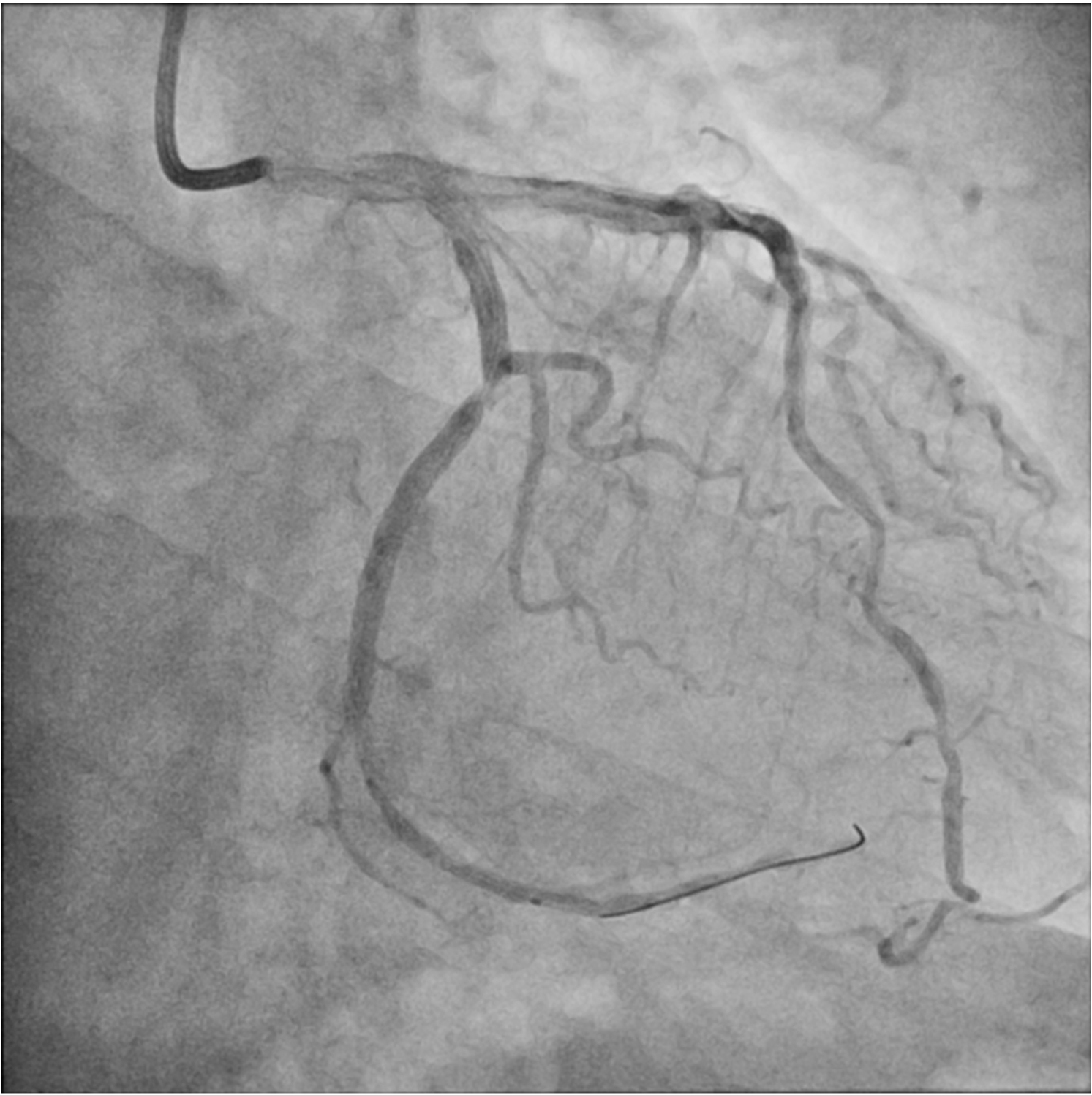 Figure 1. (B) Inadequate stent length for distal LCX lesion. 