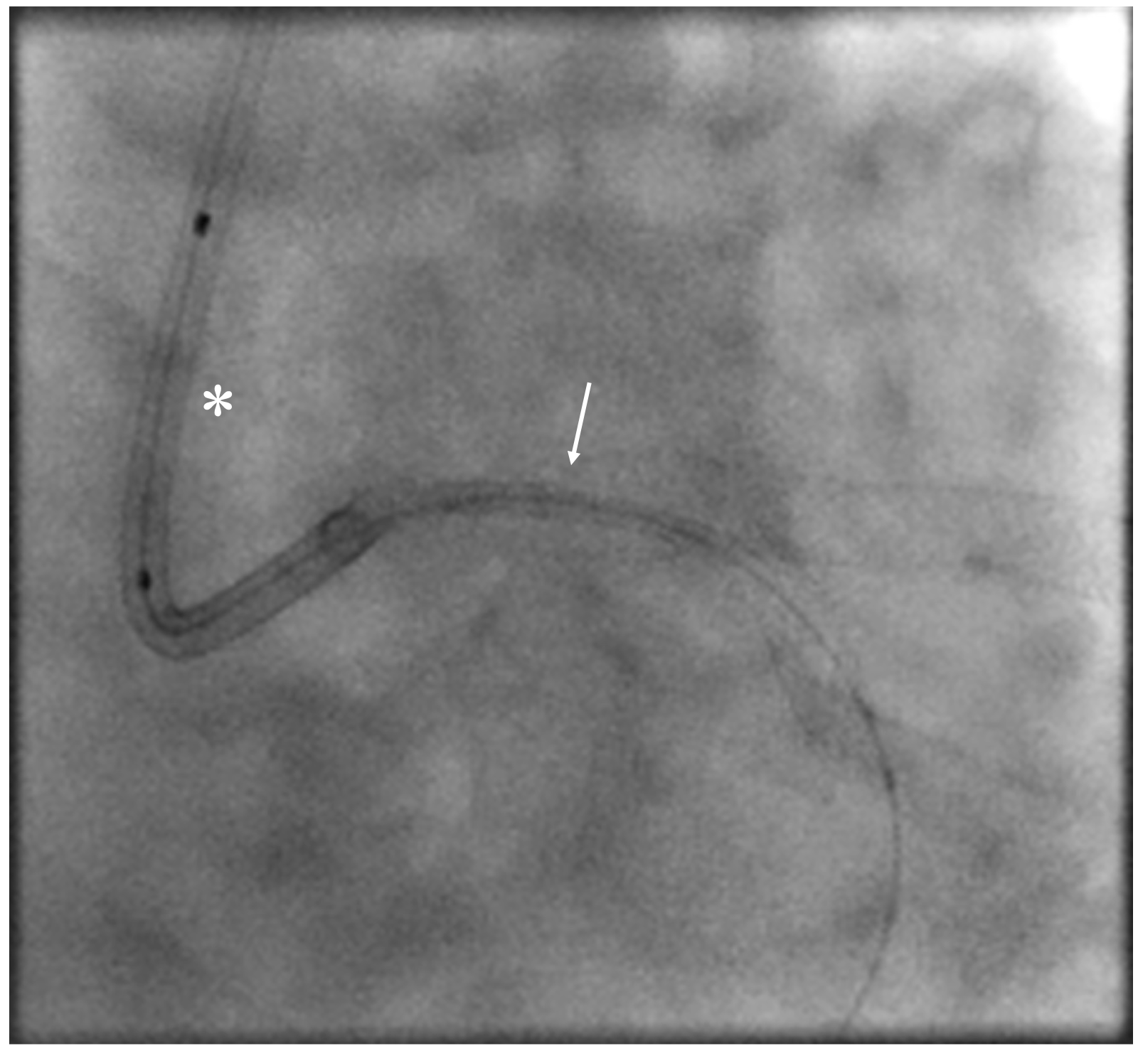 Figure 1. (C) Stent dislodged during retrieval (arrow); asterisk (*) indicates stent balloon. 