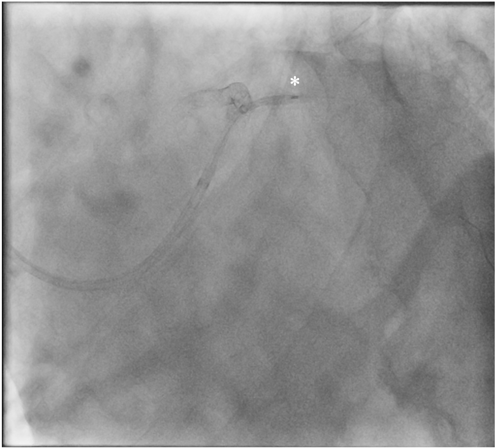 Figure 1. (D) Failed retrieval of dislodged stent 