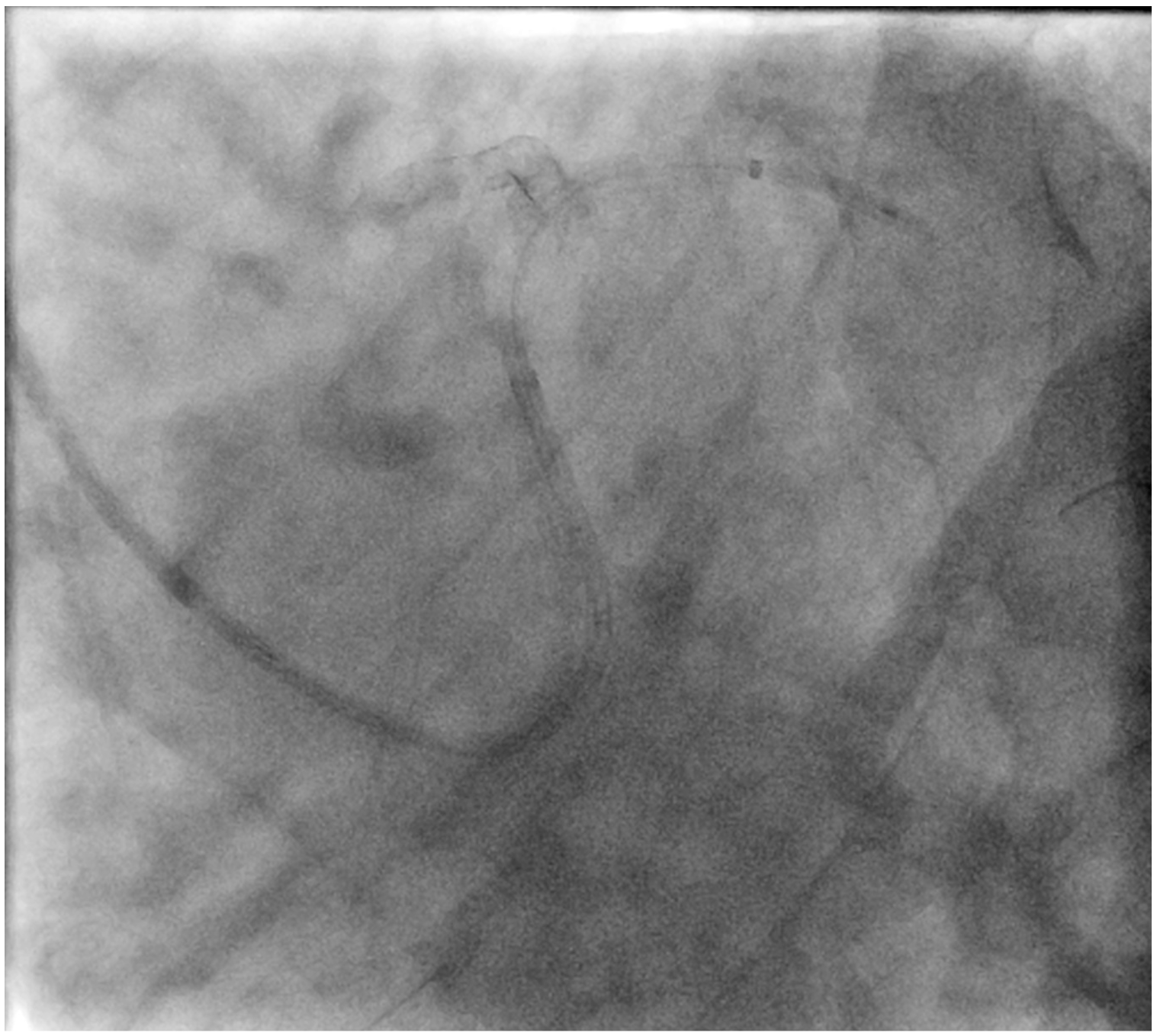 Figure 1. Coronary stent dislodgement salvaged by the Balloon-Assisted Guide-extension (BAG) system. (E) Repositioning of dislodged stent by the BAG system. 