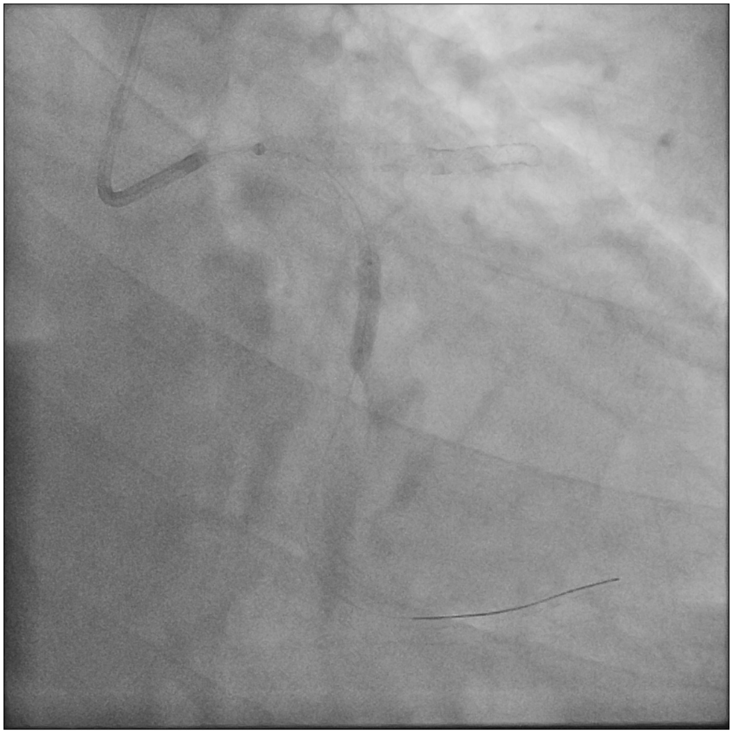 Figure 1. (G) Sequential balloon dilatation. 
