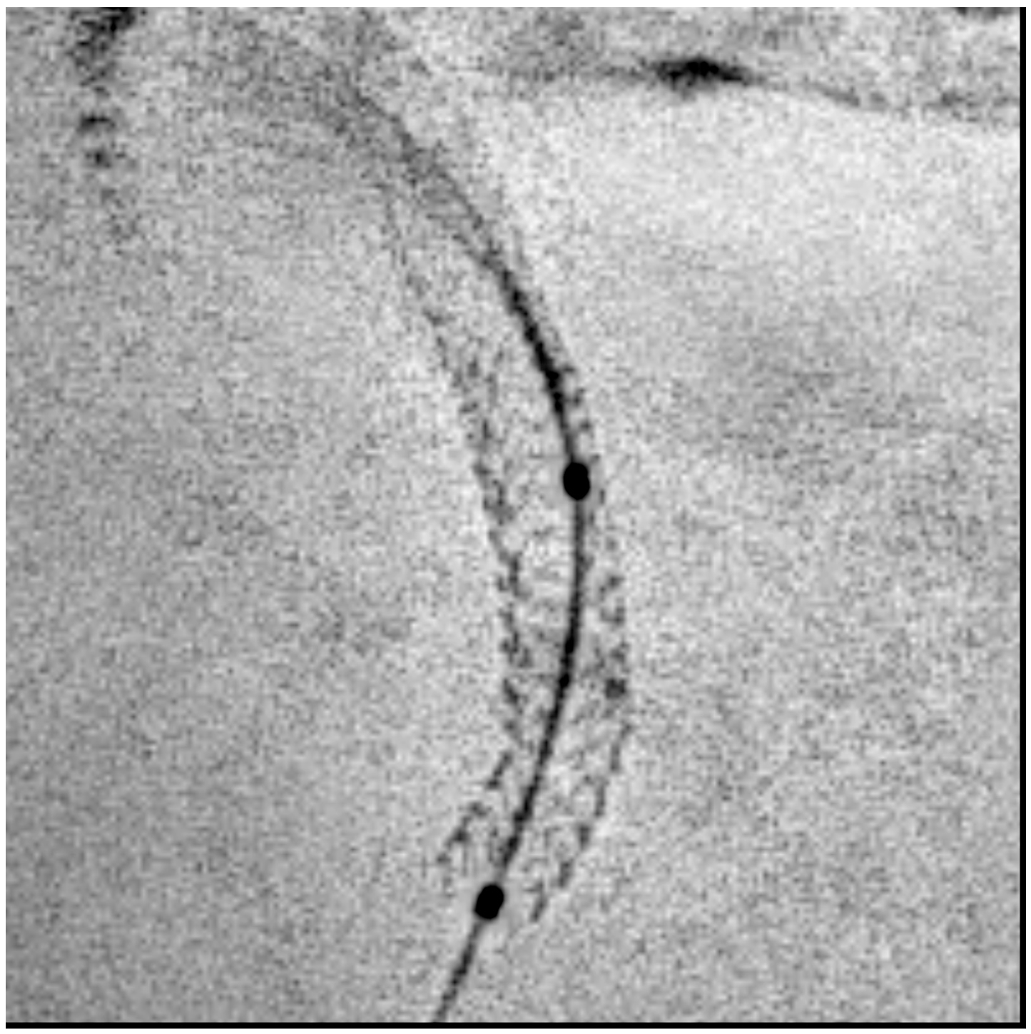 Figure 1. (H) Good stent expansion. 