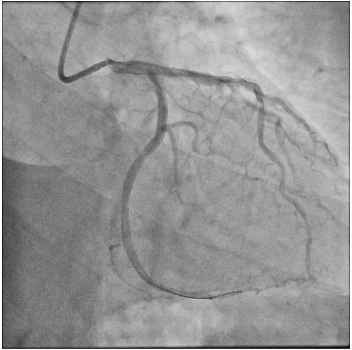 Figure 1. (J) Final angiography. 