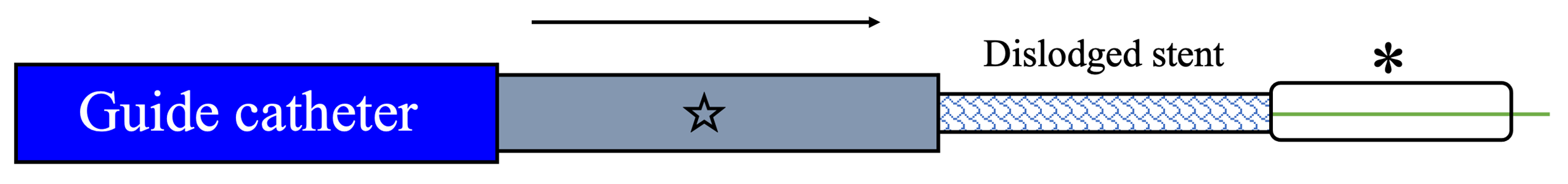 Figure 2. (C) advancement by guide extension.