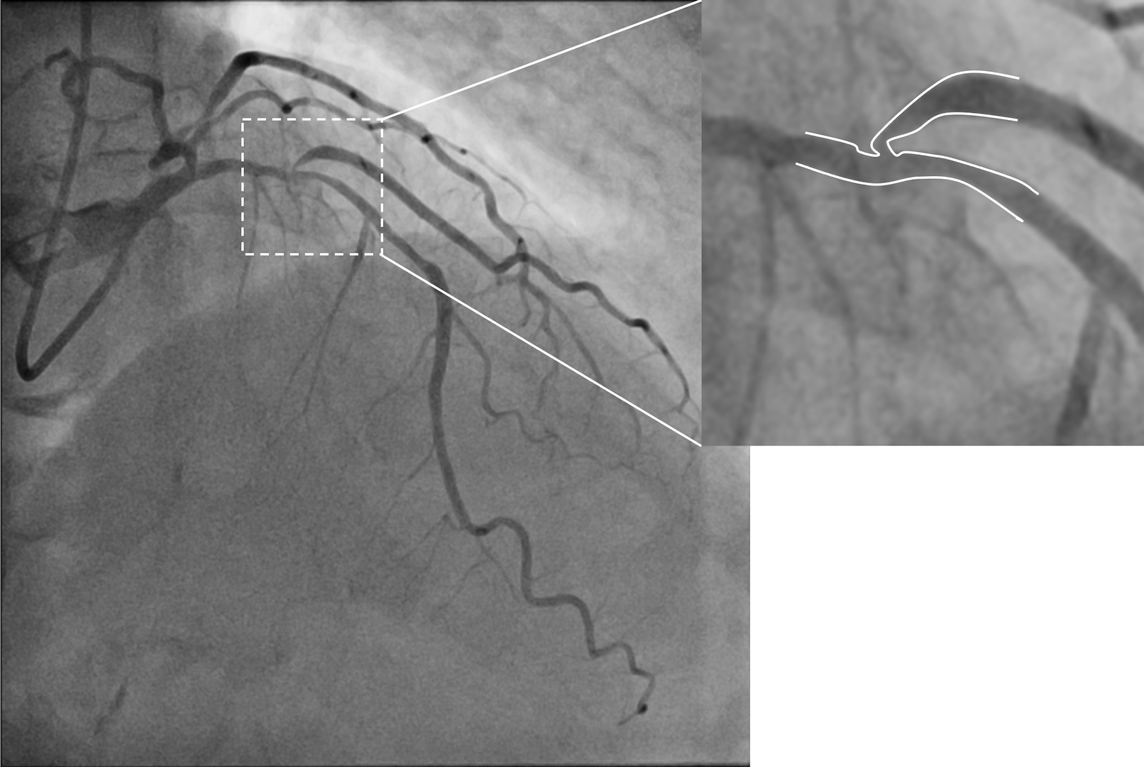 Figure. (A) Baseline angiography. 