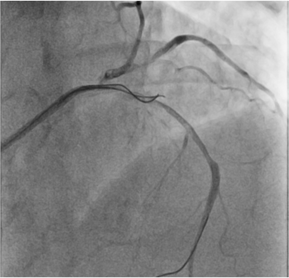 Figure. (C) Parallel wire technique. 