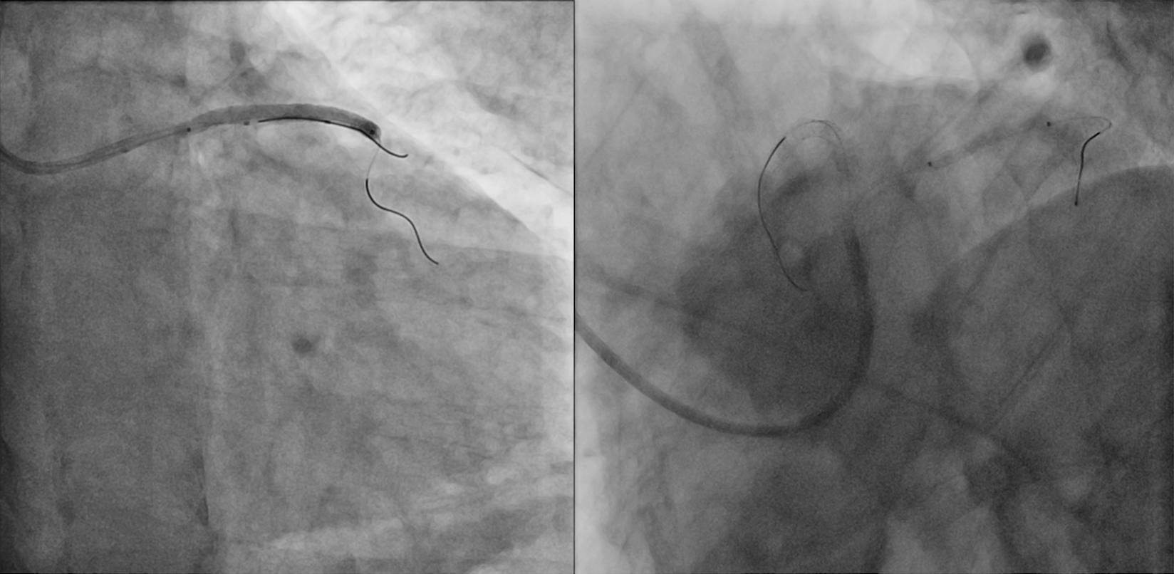 Figure. (E) Stent implantation. 