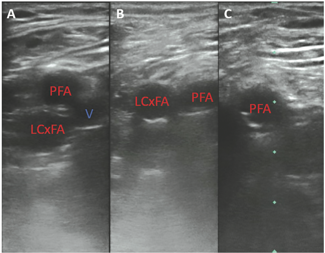 Wu Femoral Bifurcation Figure 2