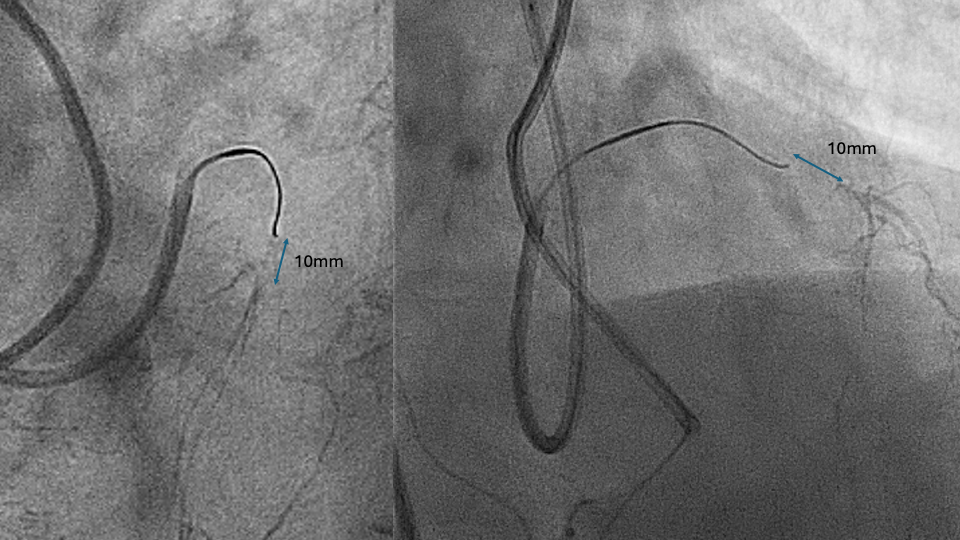 Figure 1. Stop when the antegrade wire reaches 10 mm to distal cap.