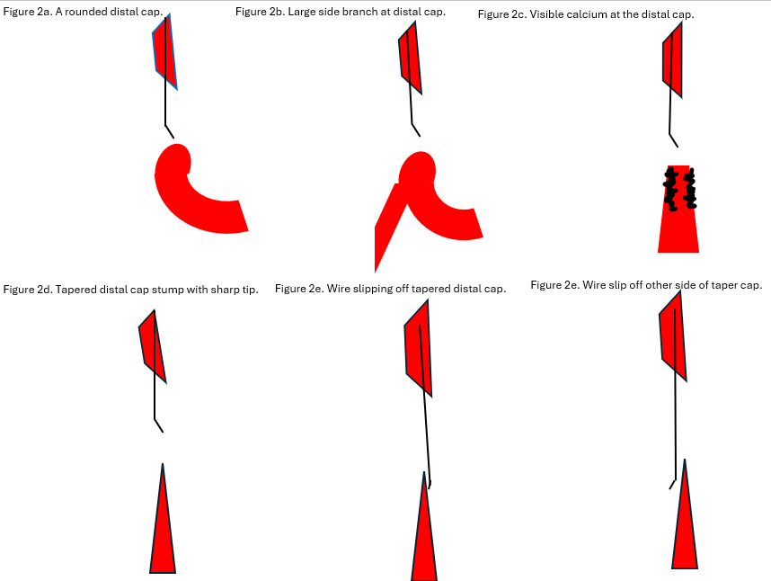 Figure 2. Four features of tough distal cap.
