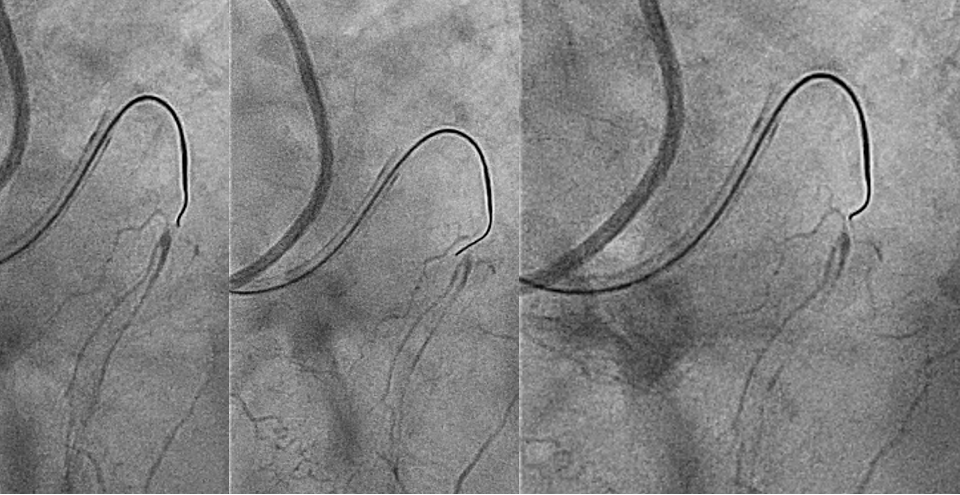 Figure 4. (A) Near-side miss of the target