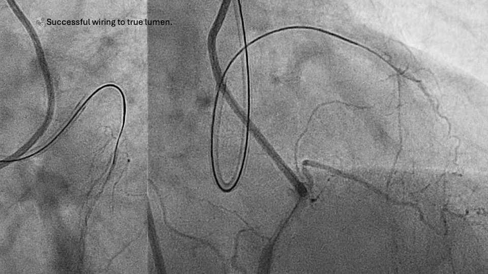Figure 5. Successful wiring into distal true lumen. 