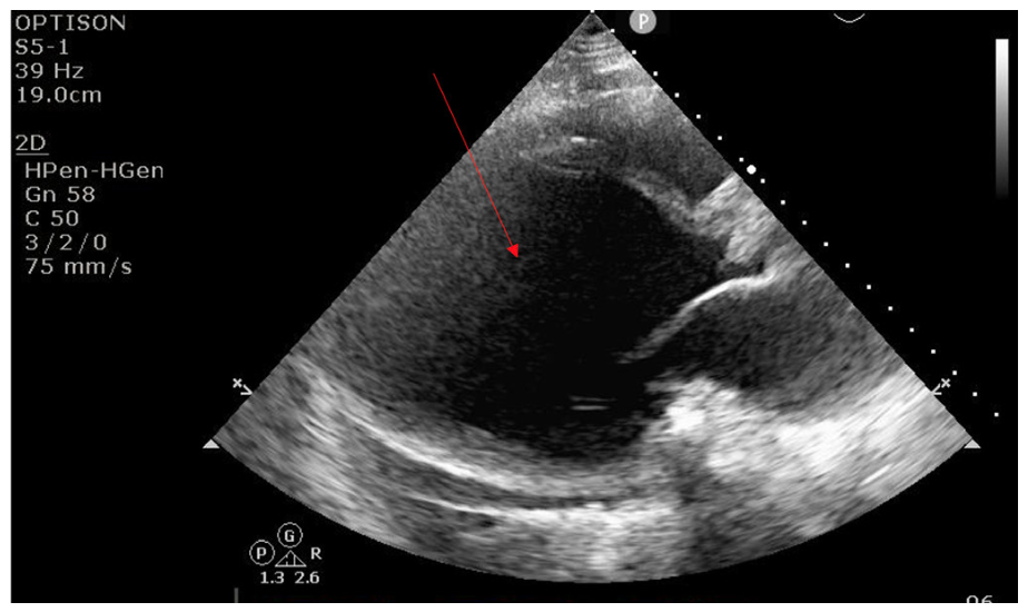 Ya'Qoub Impella Figure 1
