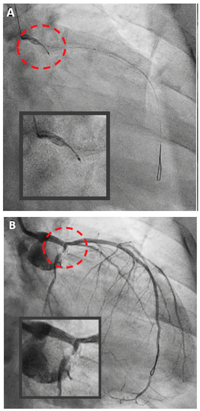 Yahya OCT Catheter Figure 2