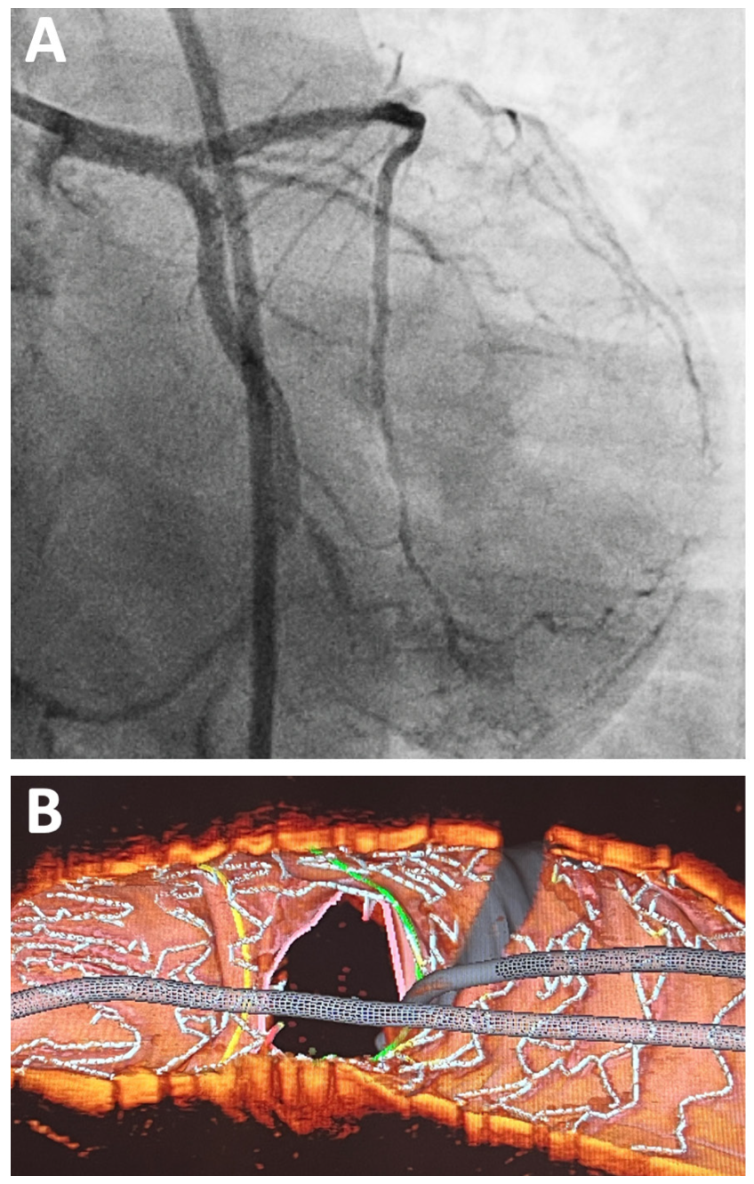 Yahya OCT Catheter Figure 4