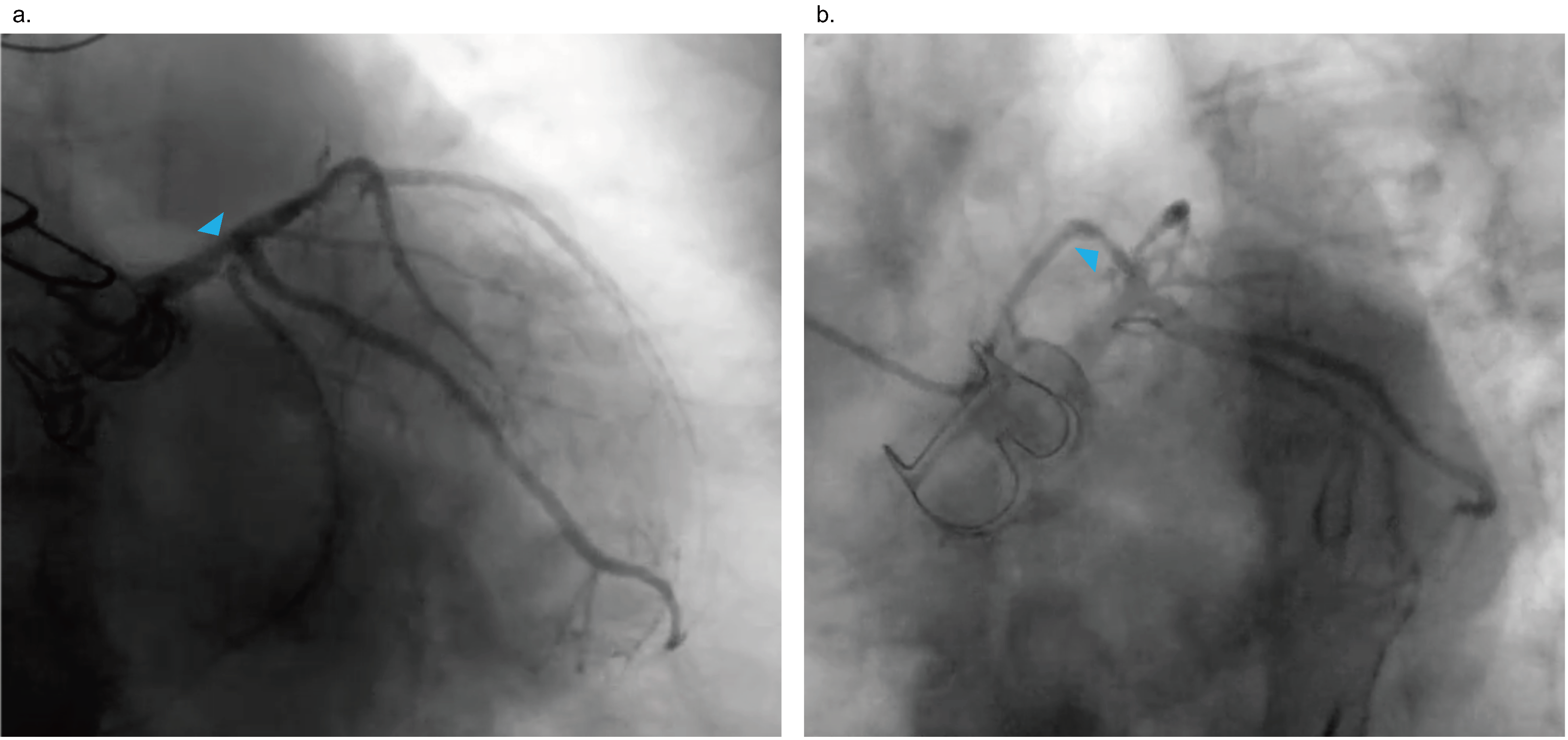 Figure. Coronary angiography 