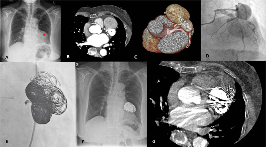 Figure. (A) Chest radiograph